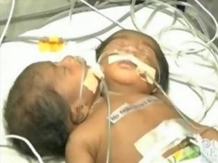 Φωτογραφία για Ινδία: Γεννήθηκε μωρό με δύο κεφάλια