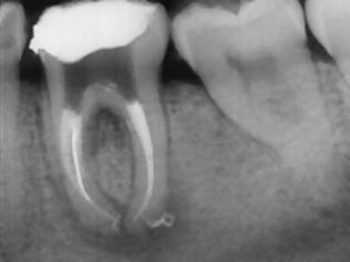 Φωτογραφία για Επικίνδυνες οι συχνές ακτινογραφίες δοντιών