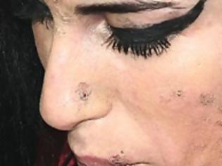 Φωτογραφία για Απομυθοποίηση μιας νεκρής σταρ στην Daily Mail: Το άρρωστο δέρμα της Είμι Γουαϊνχάουζ προκαλεί σοκ