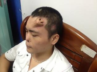 Φωτογραφία για Chinese doctor builds new nose on man's forehead