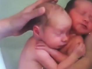 Φωτογραφία για Συγκλονιστικό βίντεο: Διδυμάκια γεννήθηκαν και παραμένουν αγκαλιασμένα