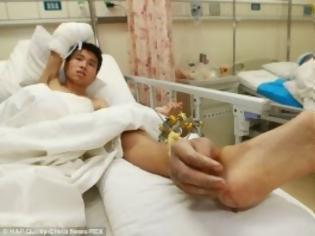 Φωτογραφία για Σοκάρει η ιστορία ενός Κινέζου που είχε κομμένο χέρι ενωμένο με τον αστράγαλό του μετά από εργατικό ατύχημα