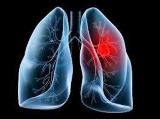 Φωτογραφία για Ο καρκίνος του πνεύμονα συχνά δεν παρουσιάζει συμπτώματα παρά μόνο αφού φτάσει σε προχωρημένο στάδιο. Η έγκαιρη διάγνωση σώζει ζωές