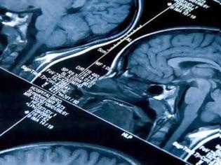 Φωτογραφία για Τι συνέβη με τον Μίκαελ Σουμάχερ - Πως ο εγκέφαλος επηρεάστηκε από το χτύπημα