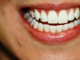 Φωτογραφία για Όσα θέλετε να μάθετε για τη Λεύκανση των δοντιών