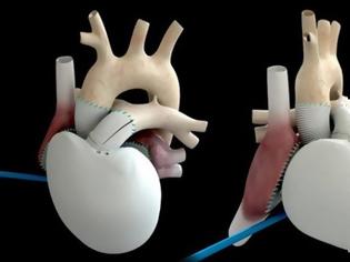 Φωτογραφία για Τεχνητή καρδιά αντί για μεταμόσχευση