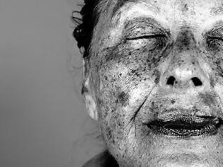 Φωτογραφία για Σοκαριστικές φωτογραφίες δείχνουν τη ζημιά που κάνει ο ήλιος στο δέρμα - Όσα δεν φαίνονται με την πρώτη ματιά