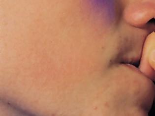 Φωτογραφία για Πέθανε επειδή έτρωγε τα νύχια του!