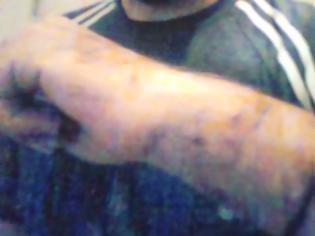 Φωτογραφία για Πάτρα: Νεαρός μηνύει αστυνομικούς για ξυλοδαρμό - Δείτε φωτο