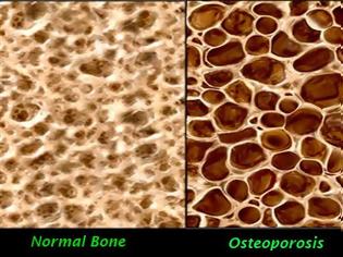 Φωτογραφία για Προλάβετε την οστεοπόρωση