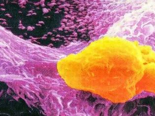 Φωτογραφία για Tα καρκινικά κύτταρα τρέφονται. Μάθετε με τι!