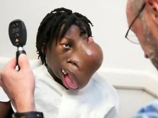 Φωτογραφία για Σοκ: Κοριτσάκι 15 ετών με τεράστιο όγκο 2 κιλών στο πρόσωπο του - Ξεκίνησε σαν ένα μικρό μπιζέλι στη μύτη του [video]