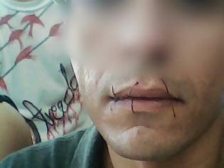 Φωτογραφία για Νησί Ναουρού: Έραψαν τα χείλη τους για να μην απελαθούν
