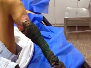 Φωτογραφία για Δείτε πως έγινε το πόδι ενός κοριτσιού ύστερα από δάγκωμα φιδιού