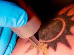 Φωτογραφία για Πως λειτουργεί η τεχνική της αφαίρεσης τατουάζ με λέιζερ [video]