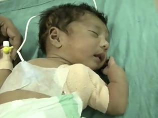 Φωτογραφία για Μωρό με τρία χέρια γεννήθηκε στην Ινδία