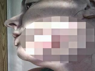 Φωτογραφία για Δείτε πως έγινε το μάγουλο μιας νεαρής κοπέλας από απόστημα στο δόντι! [photo]