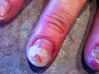 Φωτογραφία για Σοκαριστικό: Τα νύχια αυτής της γυναίκας ΚΑΤΑΣΤΡΑΦΗΚΑΝ με κάτι που κάνουν όλες οι γυναίκες [photo]