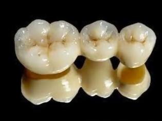 Φωτογραφία για Η οδοντιατρική γέφυρα. Τι είναι και τι πρέπει να προσέχουμε;