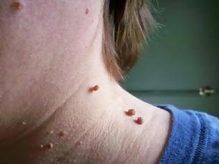 Φωτογραφία για Πως να αφαιρέσετε γρήγορα τις μικροσκοπικές ελιές από το δέρμα με μόνο ένα συστατικό! [video]
