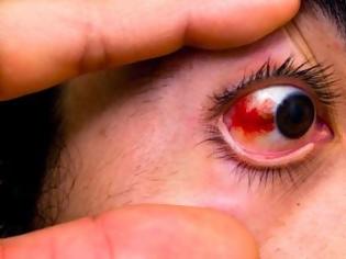 Φωτογραφία για Υπόσφαγμα: Πού οφείλεται η αιμορραγία στο μάτι