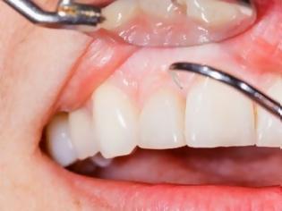 Φωτογραφία για Όταν τρίβονται τα δόντια – Τι φταίει