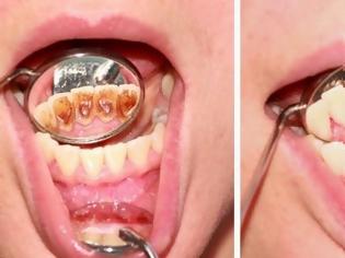 Φωτογραφία για Πώς να αφαιρέσετε την πλάκα απο τα δόντια με αυτές τις φυσικές συνταγές