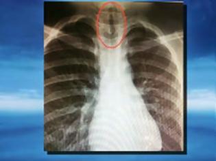 Φωτογραφία για ΑΠΙΣΤΕΥΤΟ Αυτό που βρήκαν οι γιατροί μέσα στον πνεύμονα 11χρονου [photo]