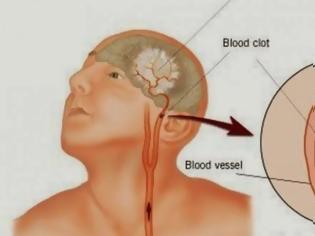 Φωτογραφία για Παίρνει μόνο ένα λεπτό για να διαβάσετε αυτό - Tι κάνουμε σε ένα εγκεφαλικό;