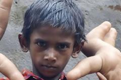Ινδία: Η ιστορία του αγοριού με τα μεγαλύτερα χέρια στον κόσμο... [photo]