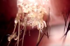 ΒΙΝΤΕΟ ΣΟΚ: Ψείρες ζούσαν στα βλέφαρα της, η φαγούρα και το τσούξιμο ήταν αφόρητα