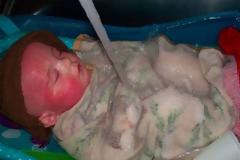 Το δέρμα του έλιωνε μέρα με τη μέρα. Μέχρι που η μητέρα του κατάλαβε τι έφταιγε…