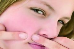 Κι όμως, η ακμή δεν είναι αποκλειστικό 