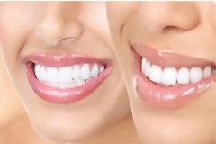 5 tricks για πιο λευκά δόντια!