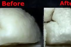 ΒΙΝΤΕΟ-ΣΟΚ: Δείτε στο μικροσκόπιο τι κάνουν τα αναψυκτικά στα δόντια σας [video]