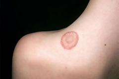 ΜΕΓΑΛΗ ΠΡΟΣΟΧΗ: Τι σημαίνει αν δείτε αυτό το σημάδι οπουδήποτε στο σώμα σας;