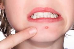 Αλοιφή με δύο υλικά καταπολεμάει ραγάδες και ακμή – Πώς να τη φτιάξετε