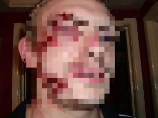 Φωτογραφία για ΣΑΛΟΣ στην showbiz: Έφαγε ξύλο γνωστός Έλληνας τραγουδιστής - Τον πλάκωσε ο άντρας της φίλης του