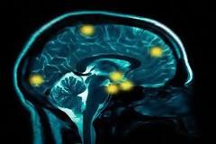 Πάρκινσον: Αιτία τα εγκεφαλικά κύτταρα με αυξημένες ανάγκες σε ενέργεια