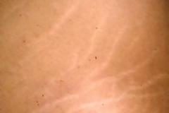 Όλες οι θεραπείες για τις ραγάδες