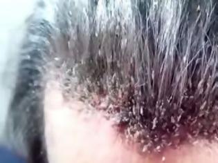 Φωτογραφία για ΑΗΔΙΑ: Μετά από αυτό θα λούζεις τα μαλλιά σου 5 φορές την ημέρα [video]