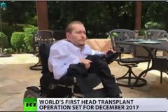 Στην Κίνα η πρώτη μεταμόσχευση κεφαλιού με κόστος 11 εκατ. δολάρια
