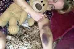 Όταν ξύπνησε, όλο της το κορμί ήταν γεμάτο μελανιές! Μετά από πέντε μέρες έμαθε την πικρή αλήθεια… [photo]