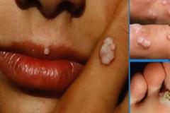 ΠΡΟΣΟΧΗ: Κυκλοφορεί ΝΕΑ ασθένεια, πιο ΘΑΝΑΤΗΦΟΡΑ από το AIDS