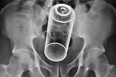 ΔΕΙΤΕ 20 παράξενα αντικείμενα που έχουν βρεθεί μέσα σε… πισινούς!