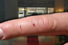 Πάφος: Στην εντατική και σοβαρά 59χρονος από δάγκωμα φιδιού