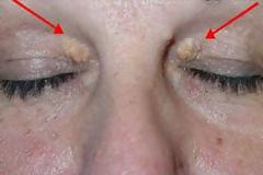 Προσοχή: Τι κίνδυνο αποκαλύπτουν αυτά τα σημάδια στα μάτια