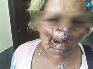 Φωτογραφία για Ρόδος: Πέντε αθίγγανοι εναντίον 34χρονης. Της δάγκωσαν και της έκοψαν τη μύτη
