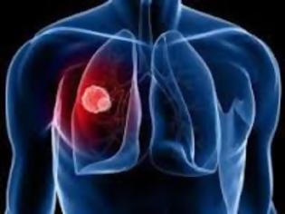 Φωτογραφία για Πως να απαλλαγείτε από τον καρκίνο του πνεύμονα με φυσικές θεραπείες