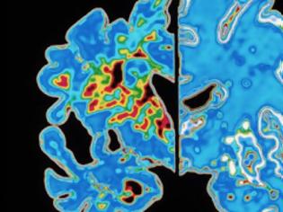 Φωτογραφία για Τεστ εικονικής πραγματικότητας προβλέπει τη νόσο Alzheimer;